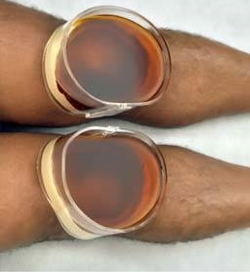 Best Panchakarma Treatment